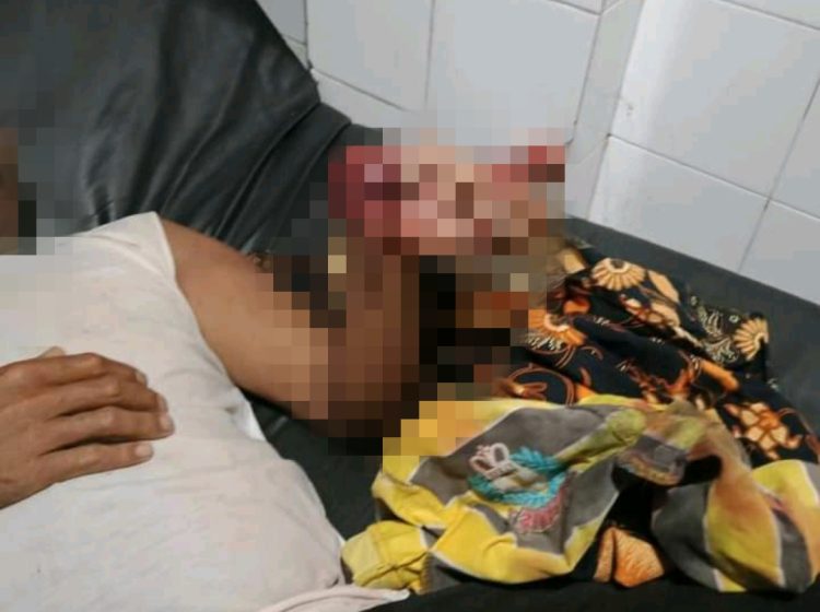 Akibat Ledakan Petasan, Tangan Warga di Loteng Hancur Hingga Diamputasi