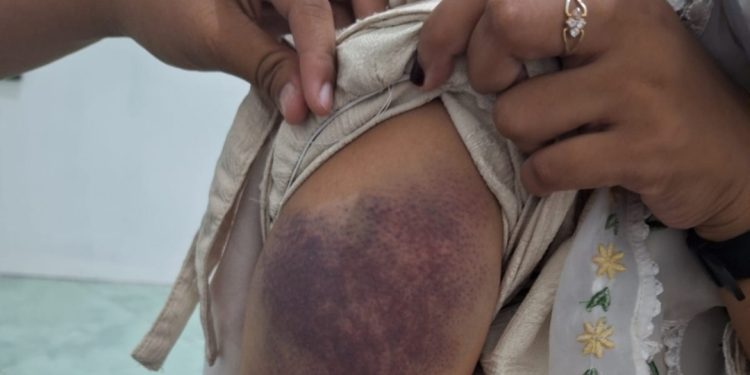 Dibakar Api Cemburu Buta, Mahasiswa di Lotim Dianiaya Pacarnya Ditengah Jalan
