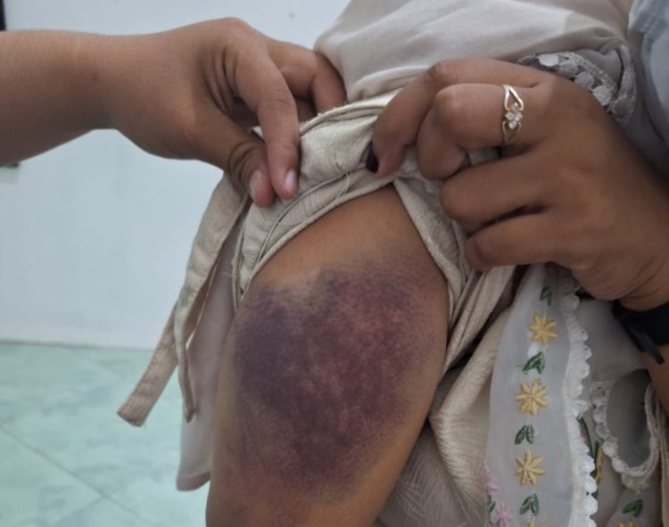 Dibakar Api Cemburu Buta, Mahasiswa di Lotim Dianiaya Pacarnya Ditengah Jalan