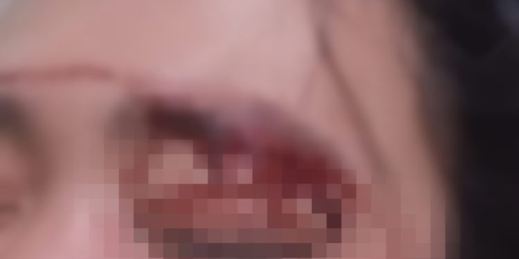 Oknum Sopir MBG di Lotim Diduga Pukul Istri Hingga Babak Belur