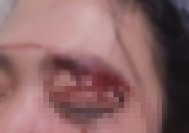 Oknum Sopir MBG di Lotim Diduga Pukul Istri Hingga Babak Belur